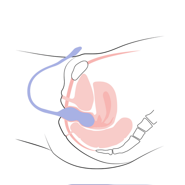 Perifit Care+ — Advanced Biofeedback Pelvic Floor Trainer